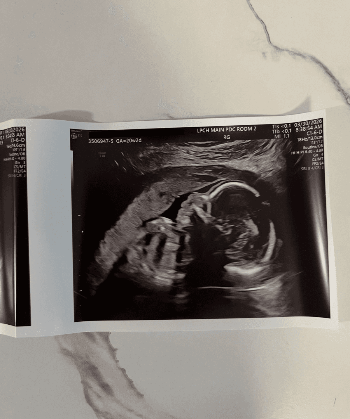 20-week ultrasound
